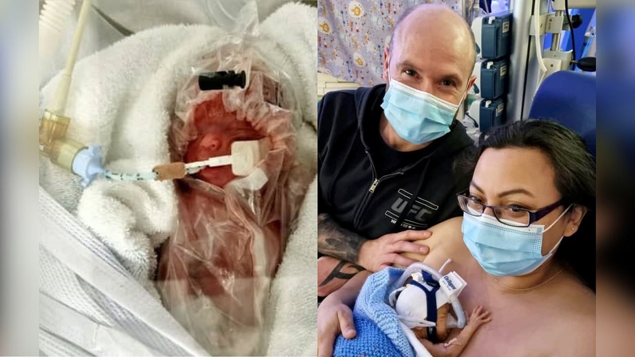 Premature baby defies odds after being placed in a plastic bag
